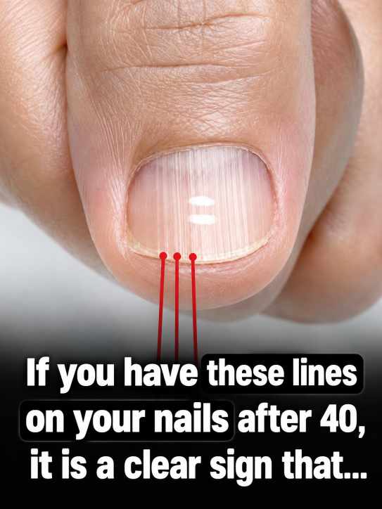 Why Vertical Lines on Your Nails Often Appear With Age